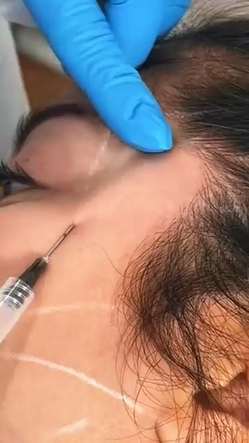 Biostimulator treatment in progress