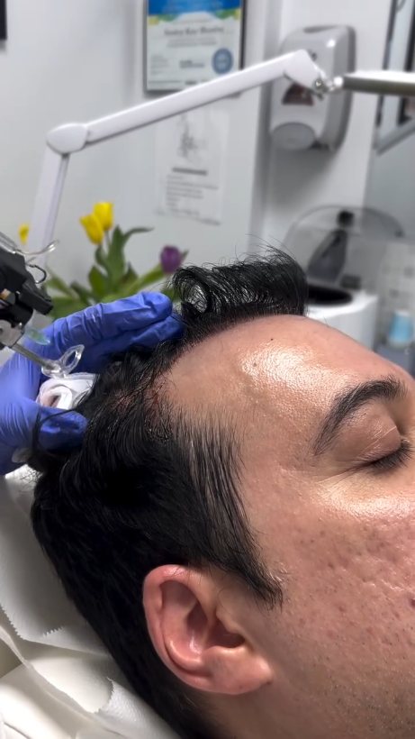 PRP injection to the scalp for hair