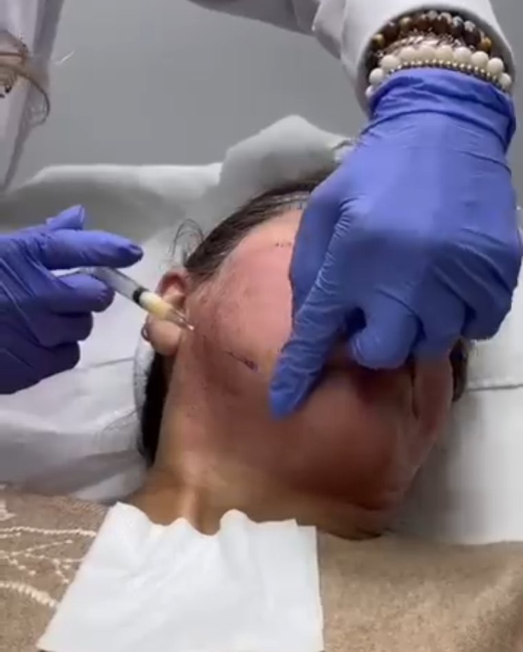PRP treatment to the skin