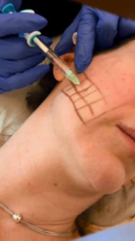 Wrinkle-relaxing injection to the forehead