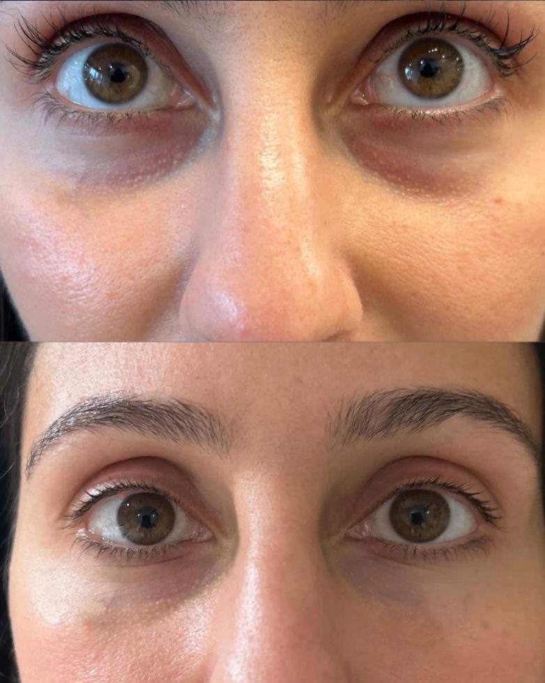 Before and after under-eye treatment