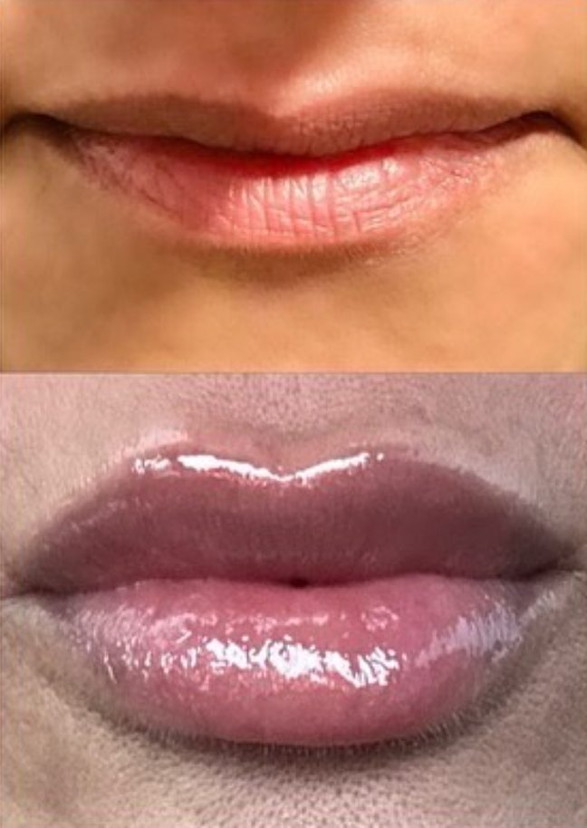 Before and after lip enhancement