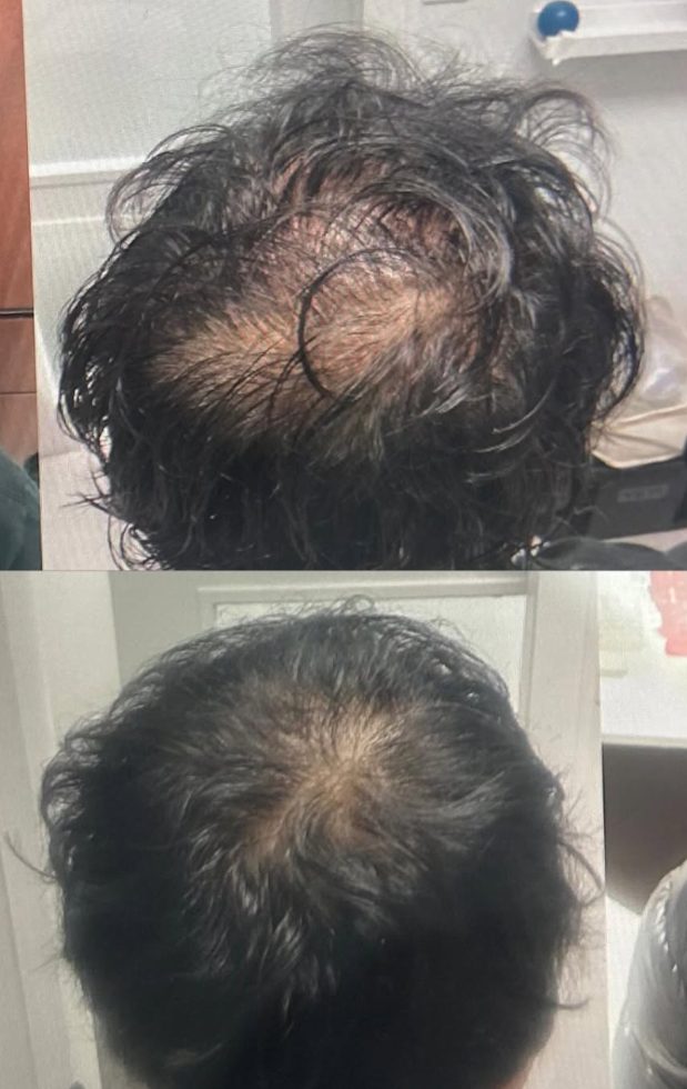 Before and after PRP hair treatment