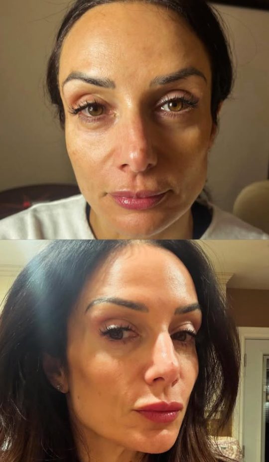Before and after full rejuvenation