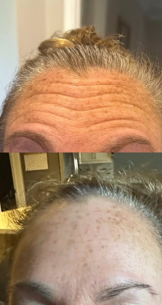 Before and after forehead lines