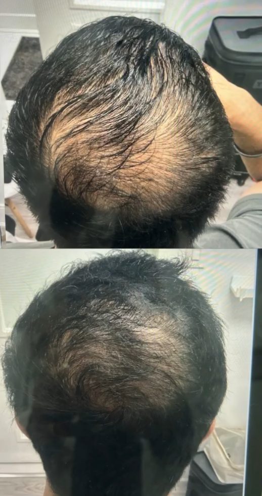 Before and after PRP hair density
