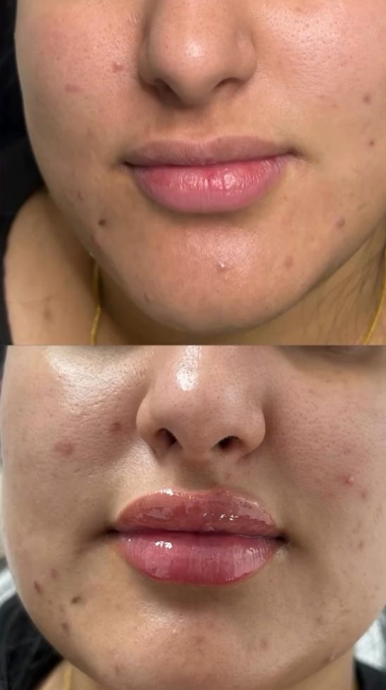 Before and after clearer skin
