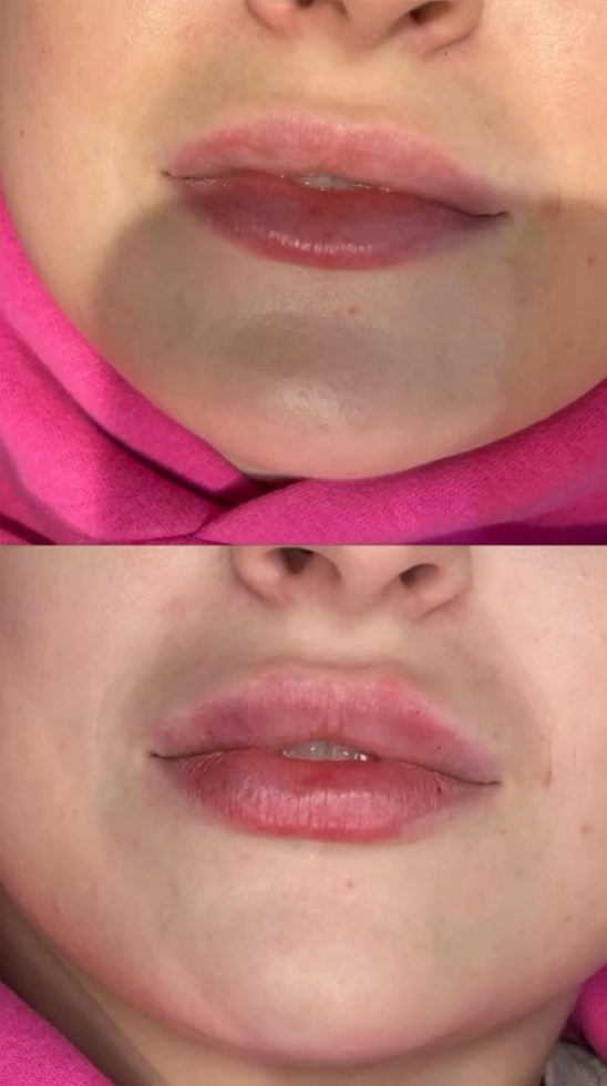 Before and after lip enhancement
