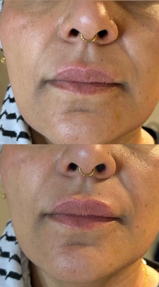 Before and after lip definition