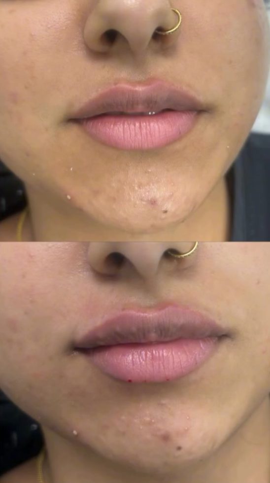 Before and after lip treatment