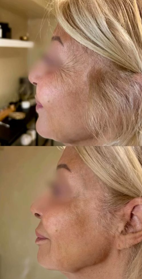 Before and after profile balancing