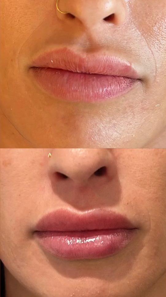 Before and after lip balance