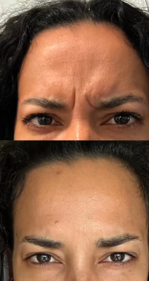 Before and after frown line treatment