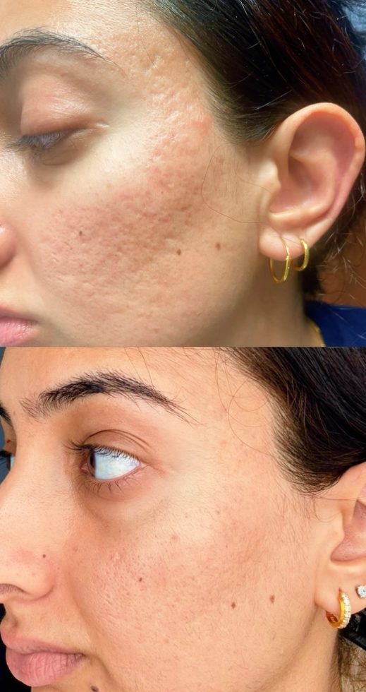 Skin texture after PRP microneedling