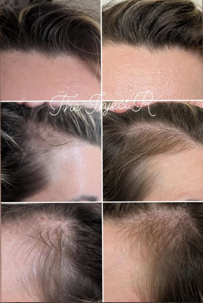 Before and after hairline regrowth