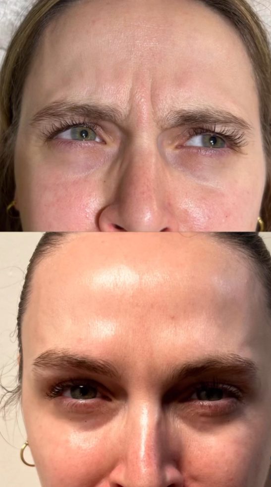 Before and after brow treatment