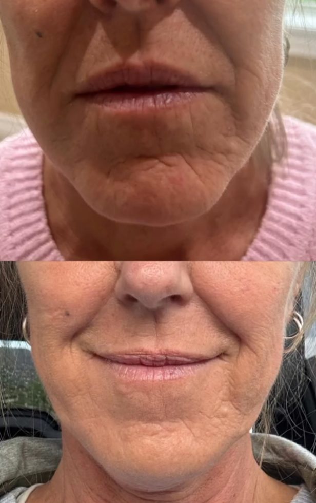 Before and after lower face tightening