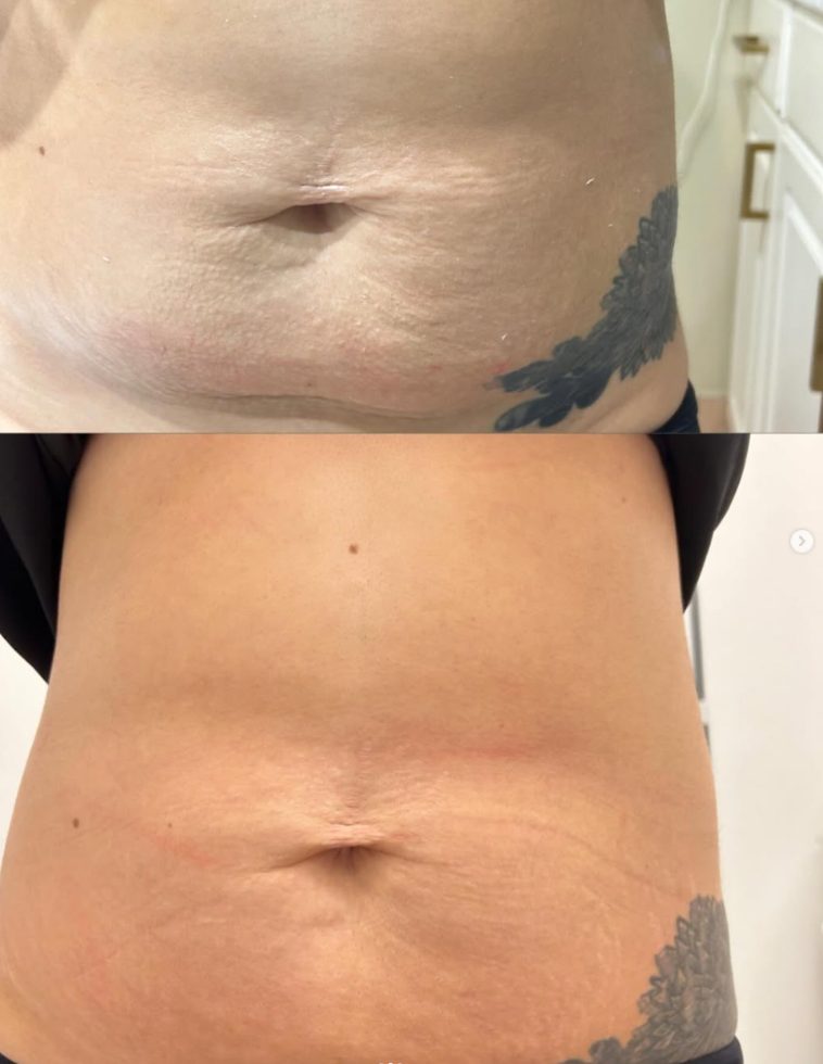 Before and after abdomen