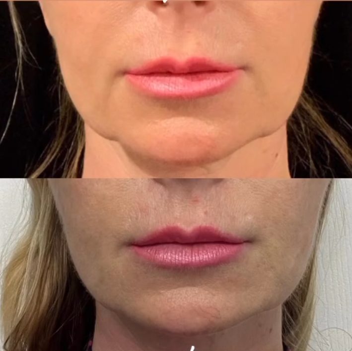 Before and after of conservative full-face balancing