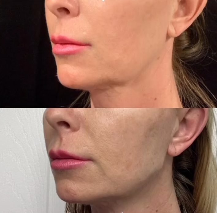 Before and after jawline contour