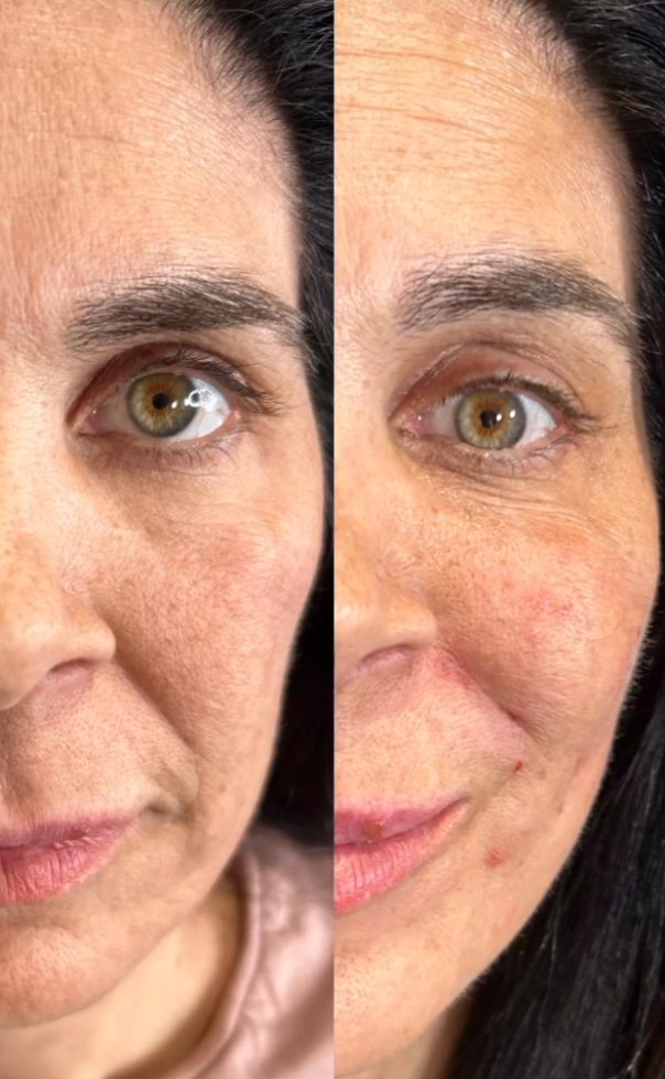 Before and after rejuvenation