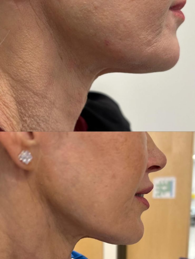 Before and after chin and neck