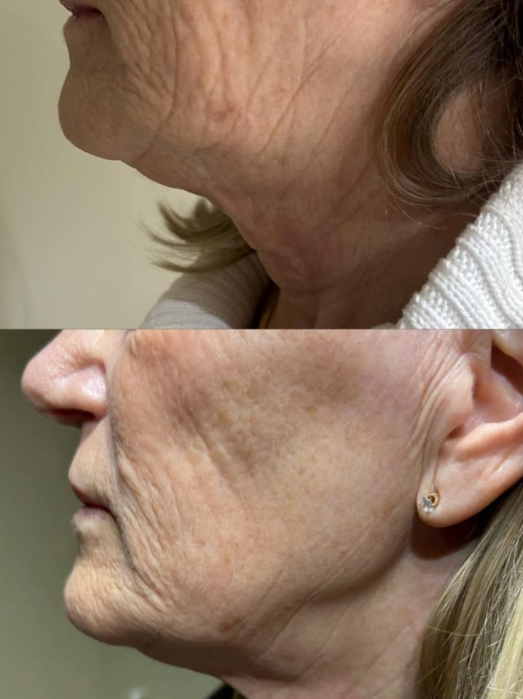 Before and after neck tightening