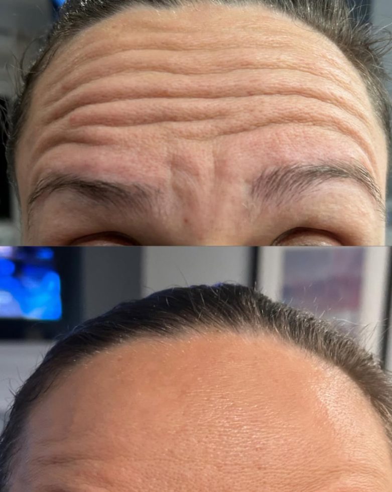 Before and after forehead treatment