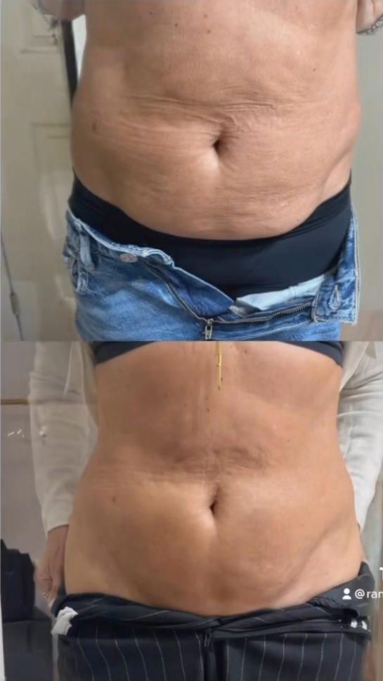 Before and after abdomen skin tightening