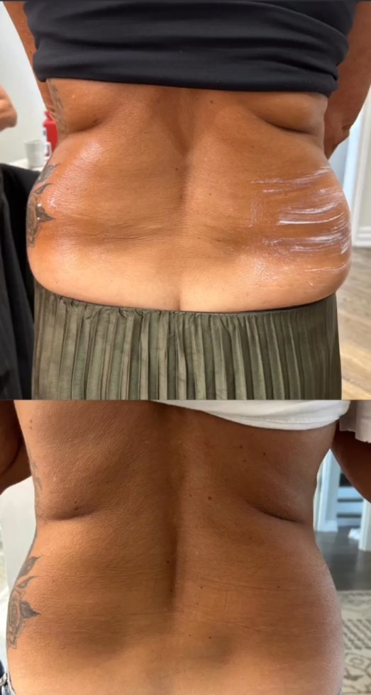 Before and after waist tightening