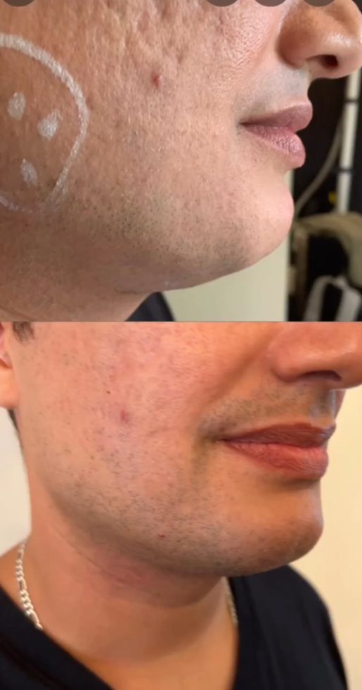 Before and after acne scarring