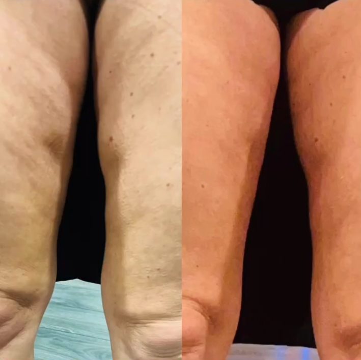 Before and after leg skin tightening