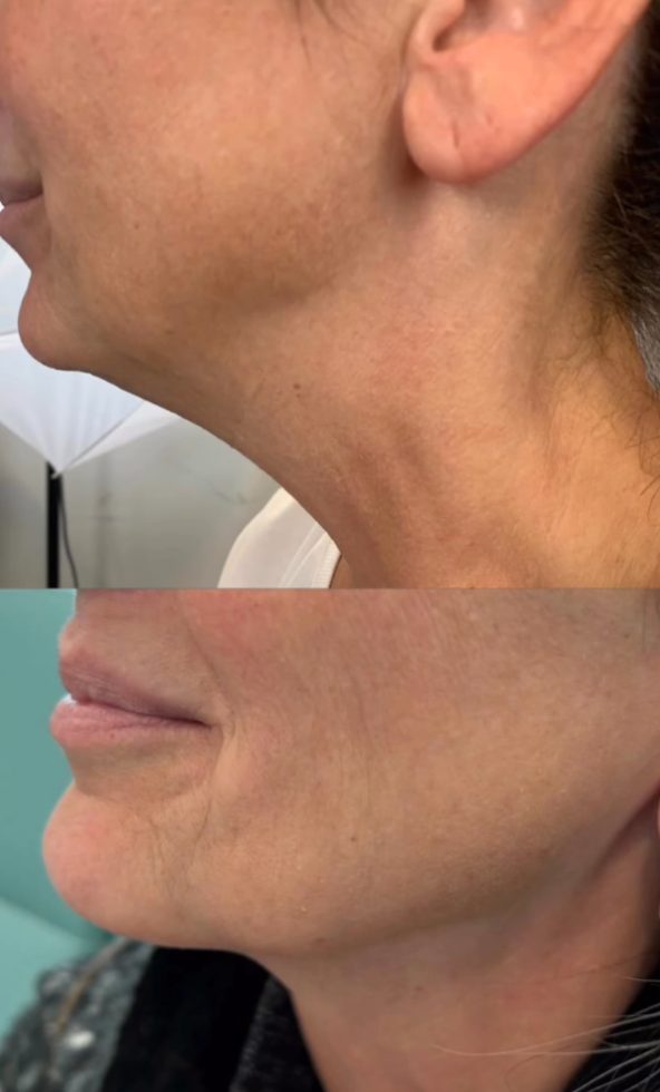 Before and after jawline definition