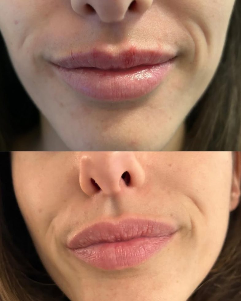 Before and after lip symmetry