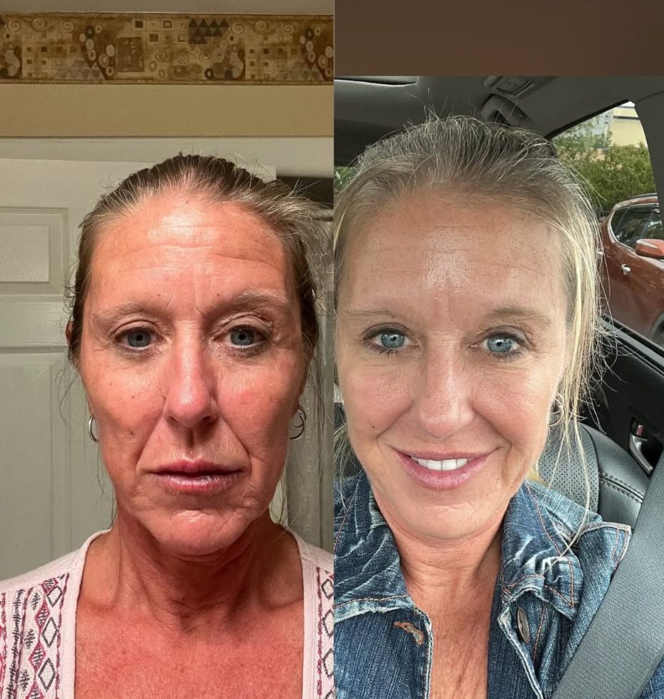 Before and after long-term results